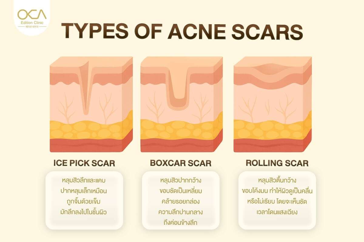Types of acne scars including ice pick, boxcar, and rolling scars