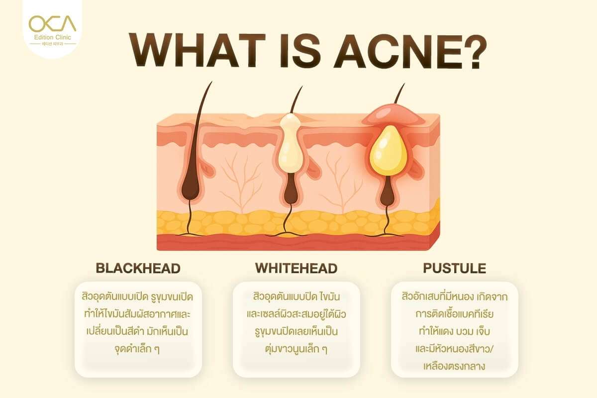 Types of acne and how acne forms on the skin