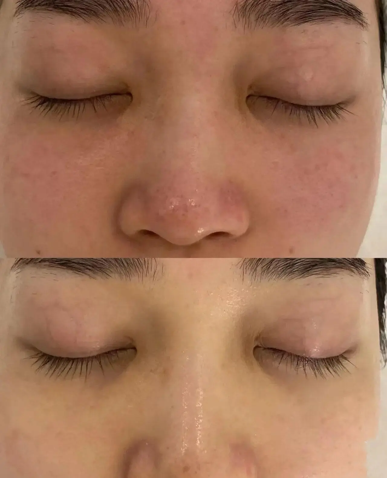LDM skin rejuvenation