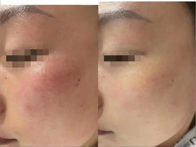 LDM inflammatory relief