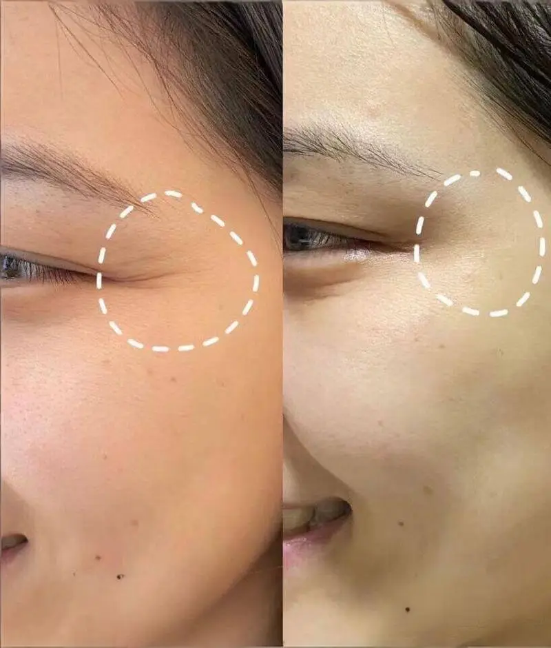 Botox Bangkok before and after - crow's feet treatment at Edition Clinic