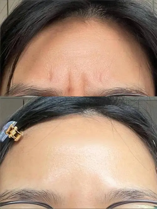 Botox Bangkok before and after - forehead wrinkle reduction at Edition Clinic