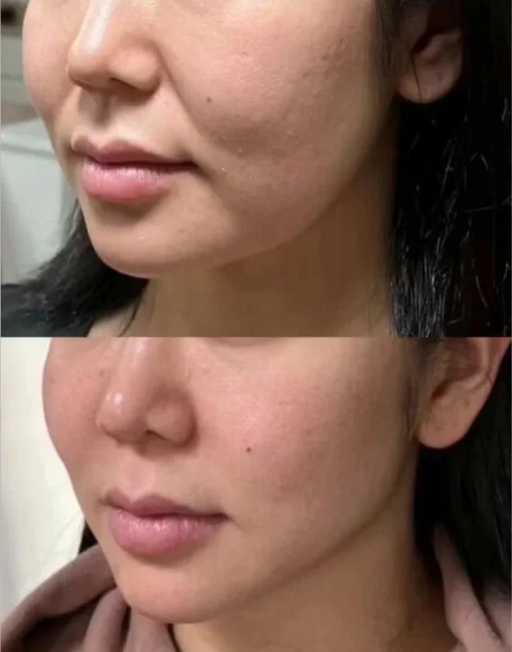 Botox Bangkok before and after - nasolabial fold reduction at Edition Clinic
