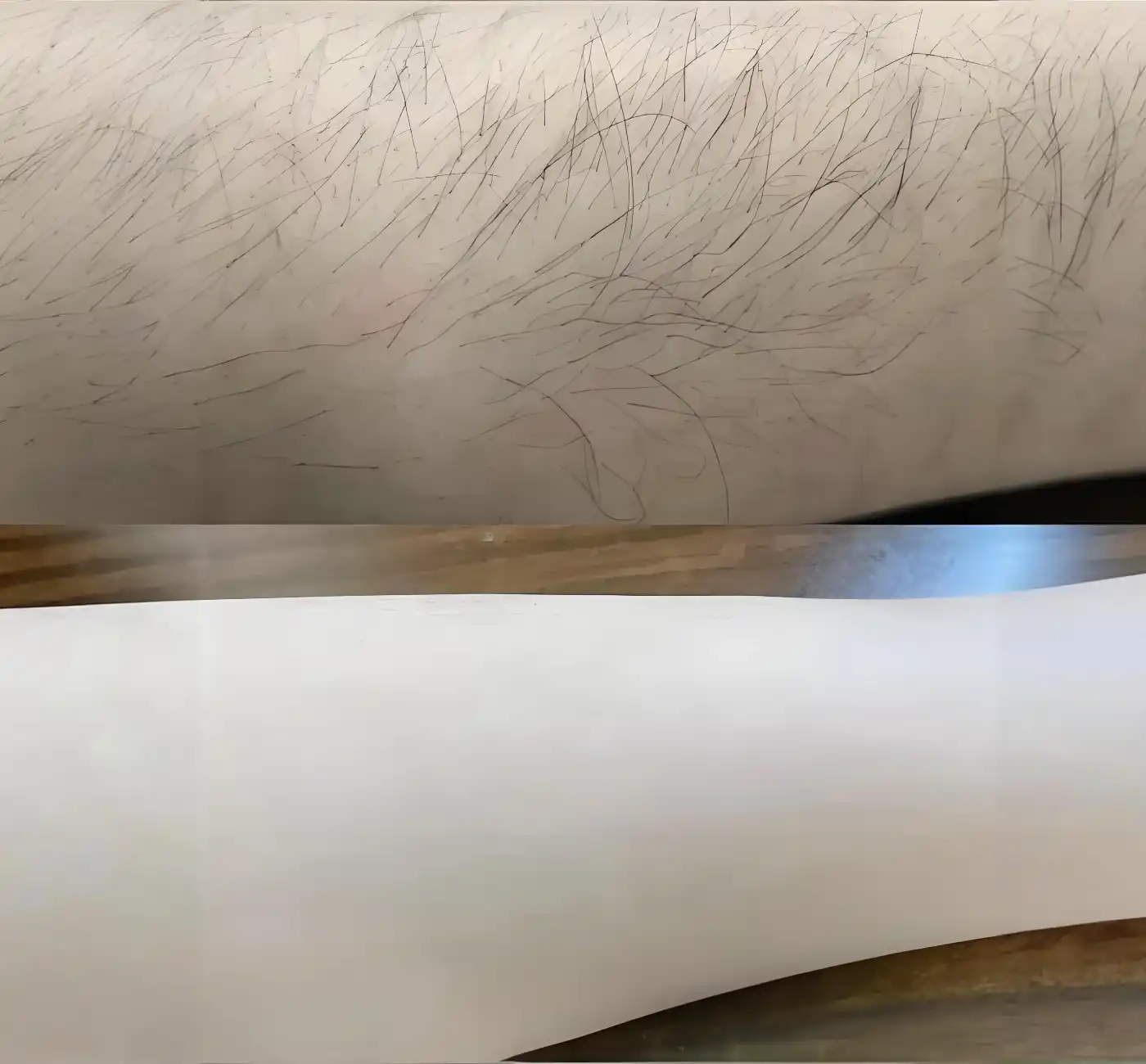 Arm laser hair removal before and after results at Edition Clinic Bangkok