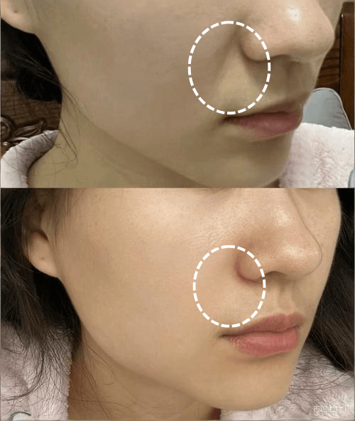 Nasolabial fold filler before and after at Edition Clinic Bangkok