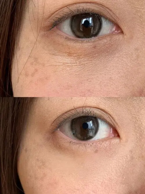 Rejuran before and after under eye wrinkle and texture improvement at Edition Clinic Bangkok