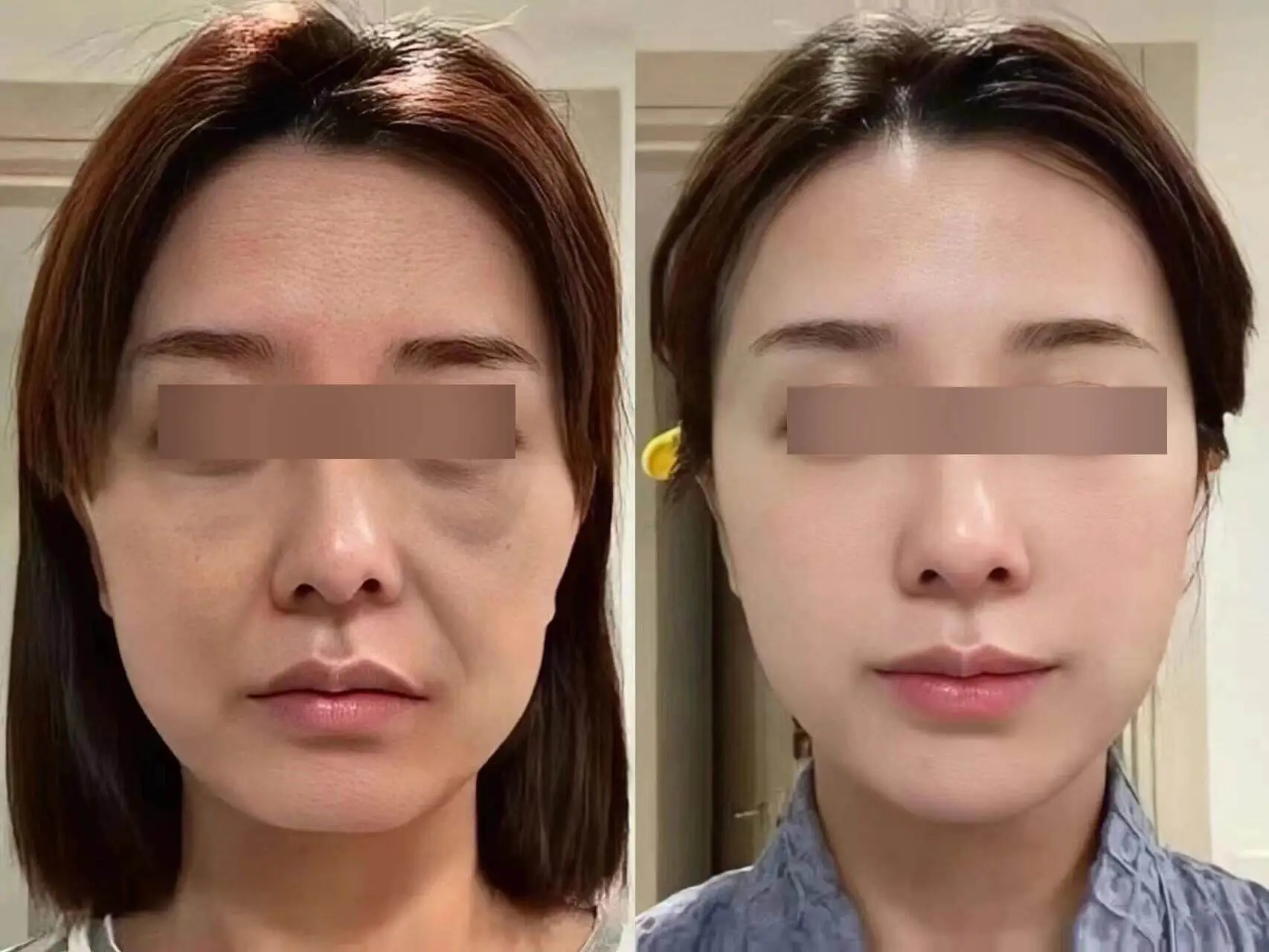 Rejuran nasolabial fold improvement and skin quality at Edition Clinic
