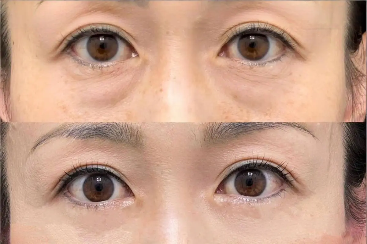 Rejuran under eye rejuvenation results at Edition Clinic Bangkok
