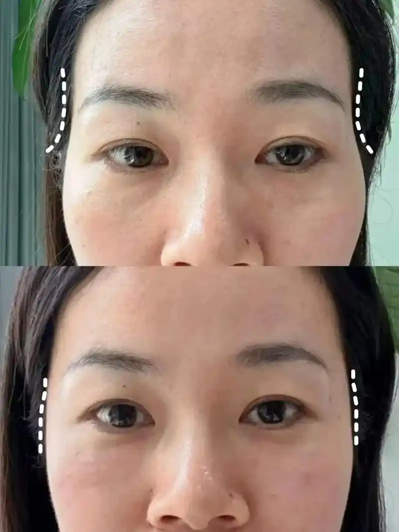 Temple volume restoration filler results at Edition Clinic Bangkok Thonglor