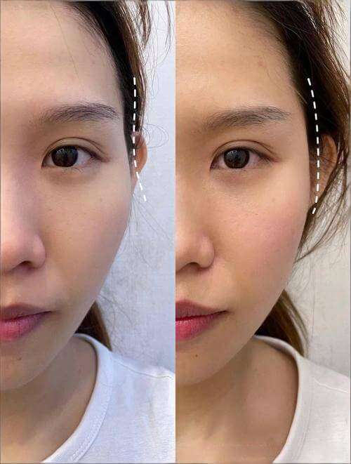 Temple volume filler before and after at Edition Clinic Bangkok Thonglor