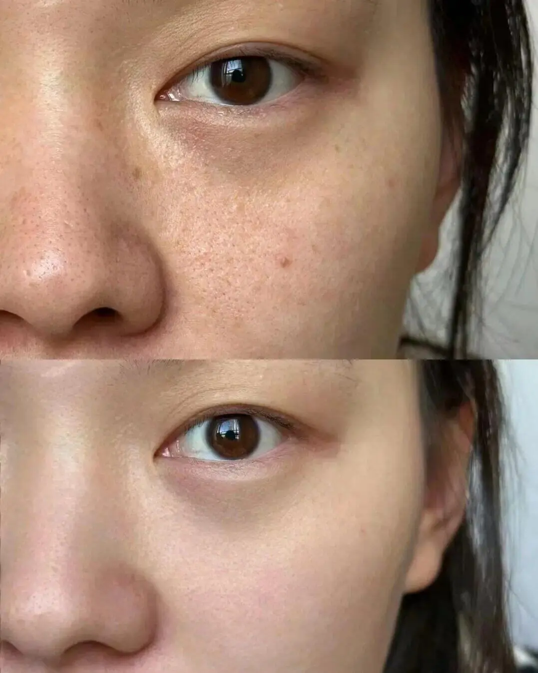 Pigmentation and dark spot removal after Potenza RF Microneedling at Edition Clinic