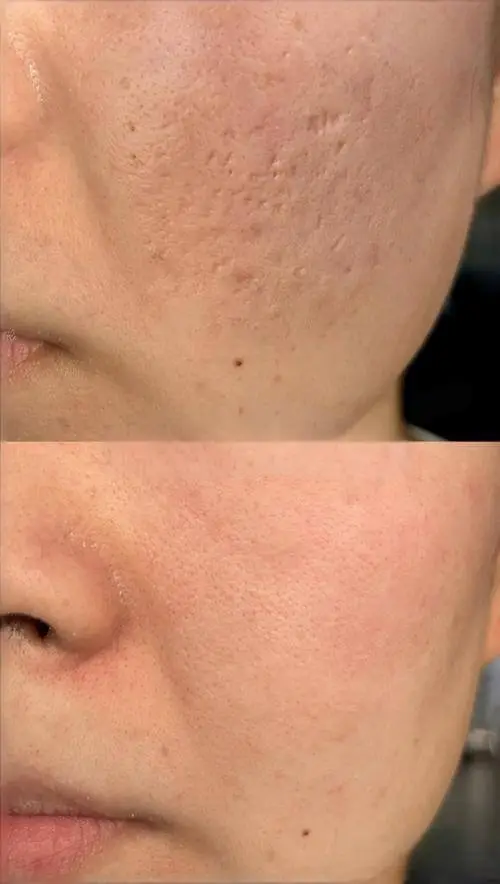 Acne scar and pore reduction results after RF Microneedling at Edition Clinic Thonglor
