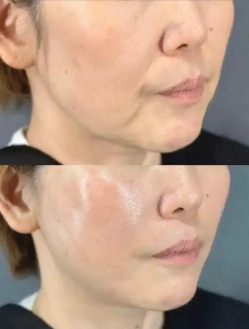 Nasolabial fold lifting results after Ultraformer MPT at Edition Clinic Thonglor