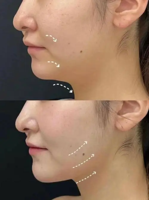 Double chin reduction before and after with Ultraformer MPT at Edition Clinic Bangkok