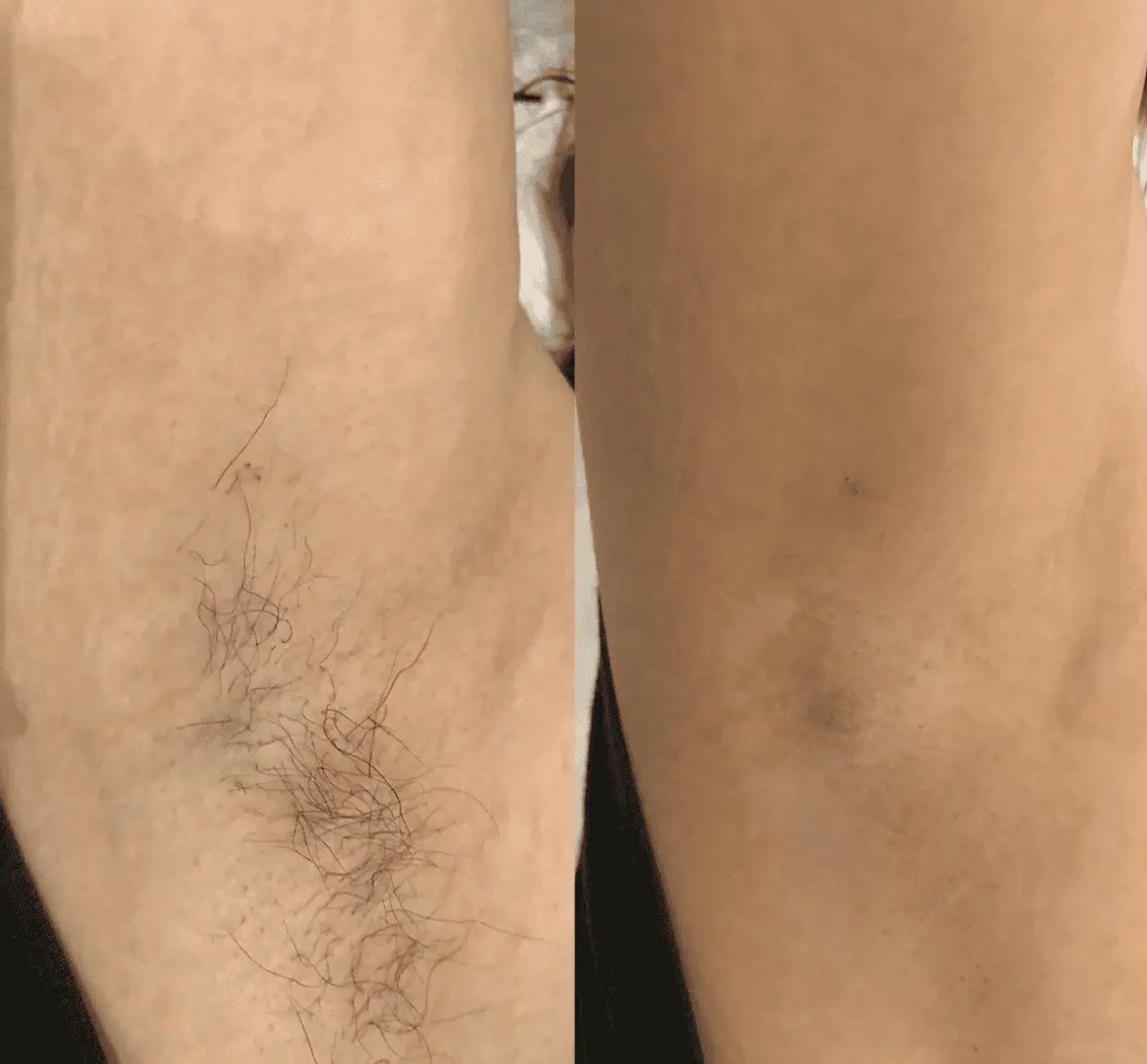 Underarm hair removal before and after with Alexandrite laser Bangkok