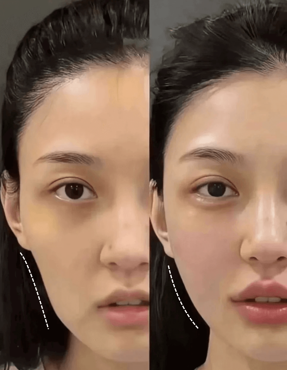 Cheek filler before and after results at Edition Clinic Bangkok