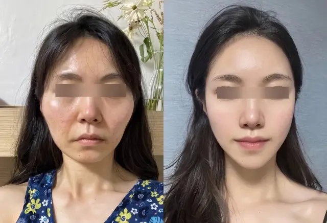 Juvelook before and after - face contour and skin quality improvement