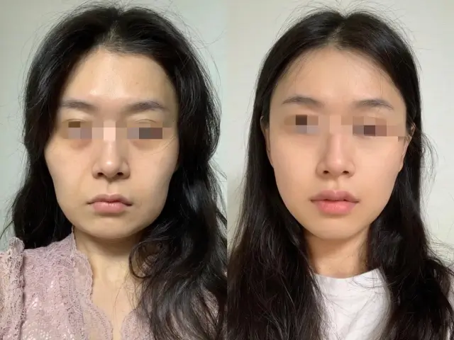 Juvelook in Bangkok before and after - full face skin rejuvenation