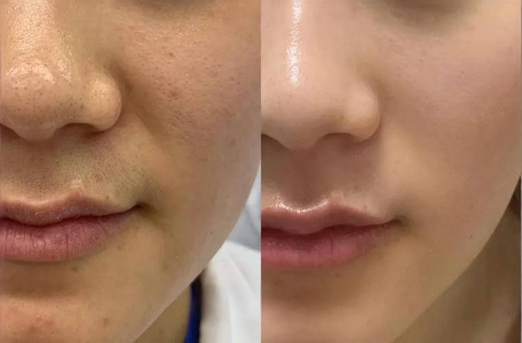 Juvelook before and after - pores and texture refinement