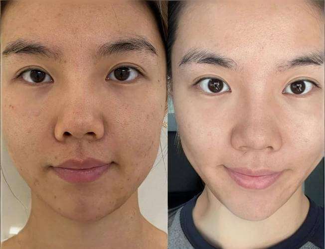 Juvelook before and after - skin tone brightening results