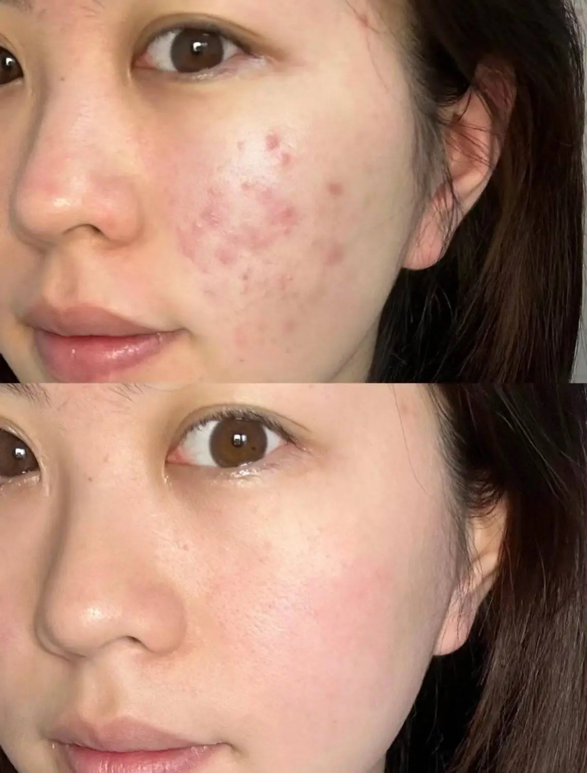 Before and after acne redness improvement with Potenza RF Microneedling at Edition Clinic Bangkok