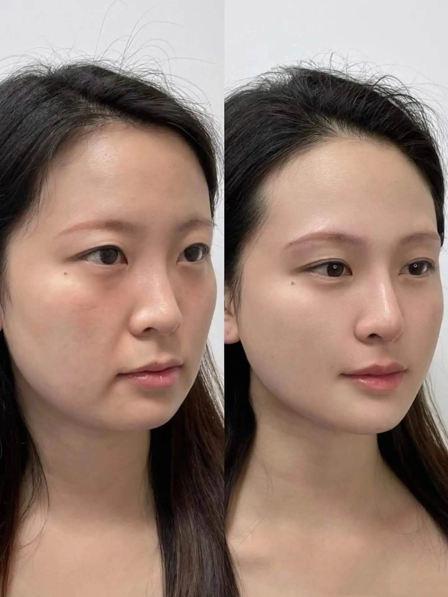 Facial lifting and skin tightening results from Potenza treatment at Edition Clinic Bangkok