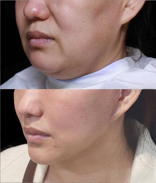 Jawline contouring and V-line sculpting with Ultraformer MPT at Edition Clinic Bangkok
