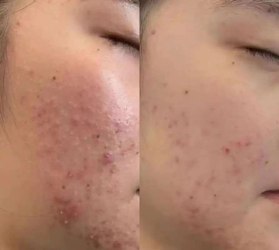 Clear skin achievement before and after acne treatment at Edition Clinic Bangkok