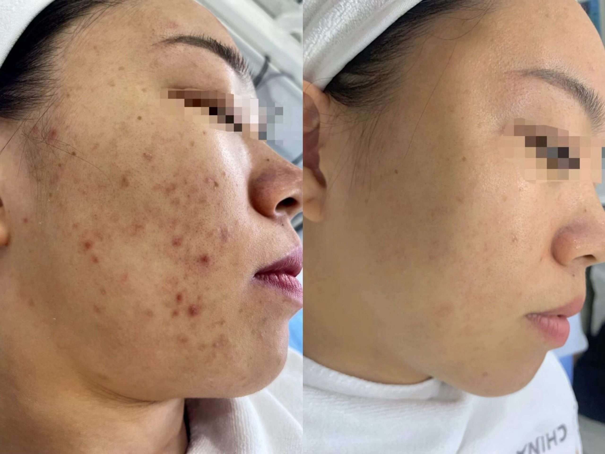 Acne inflammation calming before and after Gold PTT treatment at Edition Clinic Bangkok