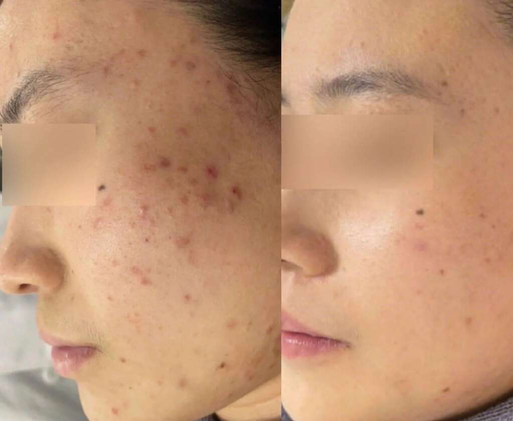 Skin barrier repair and redness reduction before and after Rejucell treatment at Edition Clinic