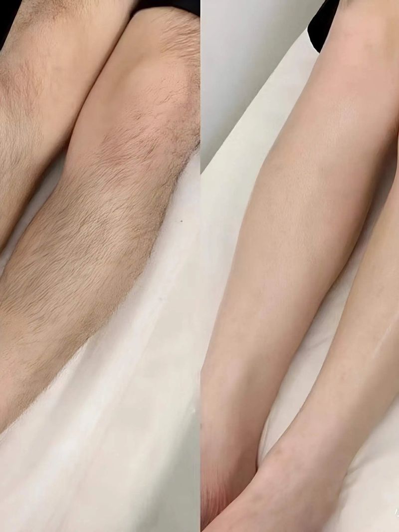Full leg laser hair removal before and after results at Edition Clinic Thonglor
