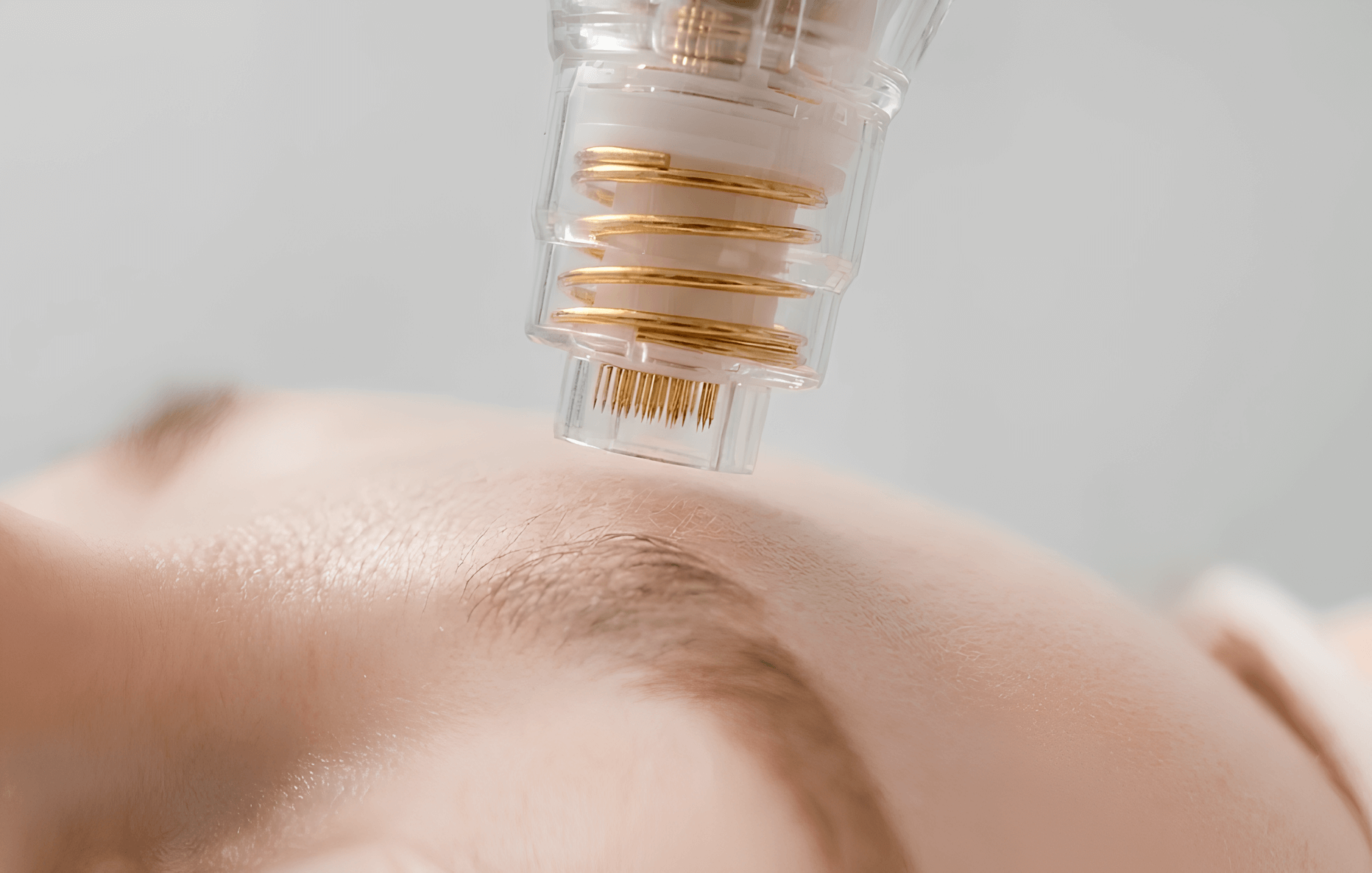 RF Microneedling Potenza treatment for acne scars and pores at Edition Clinic Bangkok