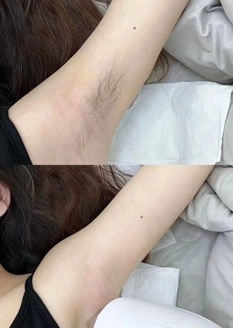 Underarm laser hair removal before and after results at Edition Clinic Bangkok
