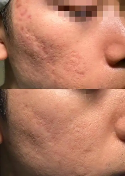 Pore refinement before and after results at Edition Clinic Thonglor Bangkok