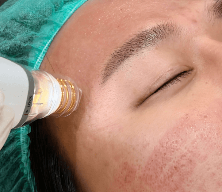 Acne scar treatment program at Edition Clinic Bangkok