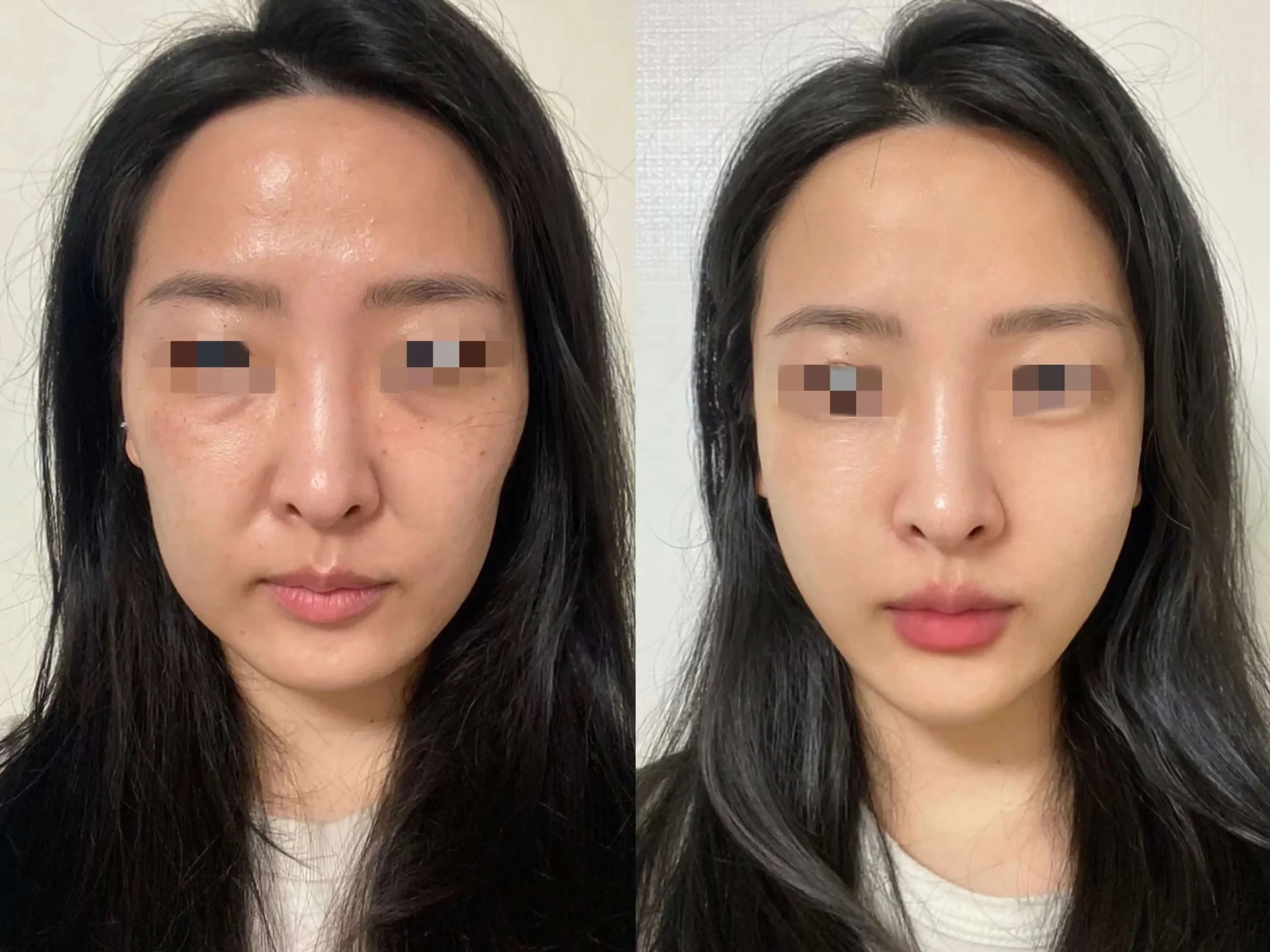 Sculptra Bangkok before and after - full face volume restoration at Edition Clinic
