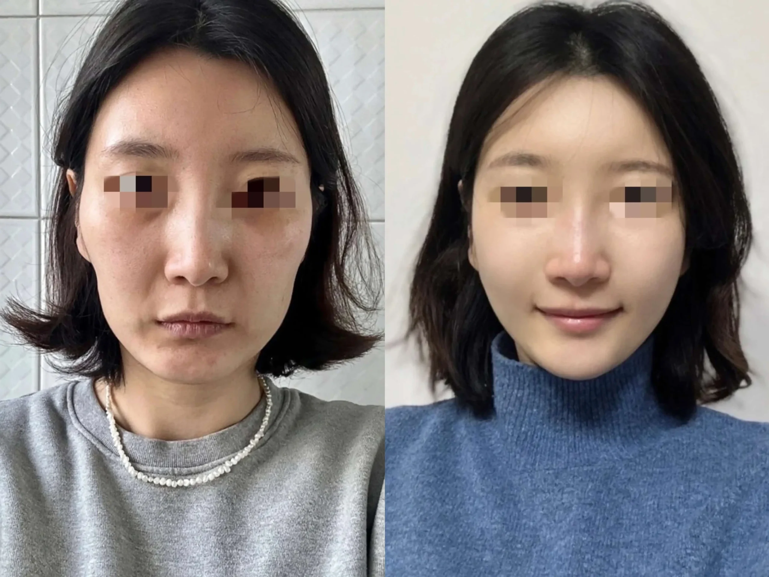 Sculptra Bangkok before and after - nasolabial fold improvement at Edition Clinic