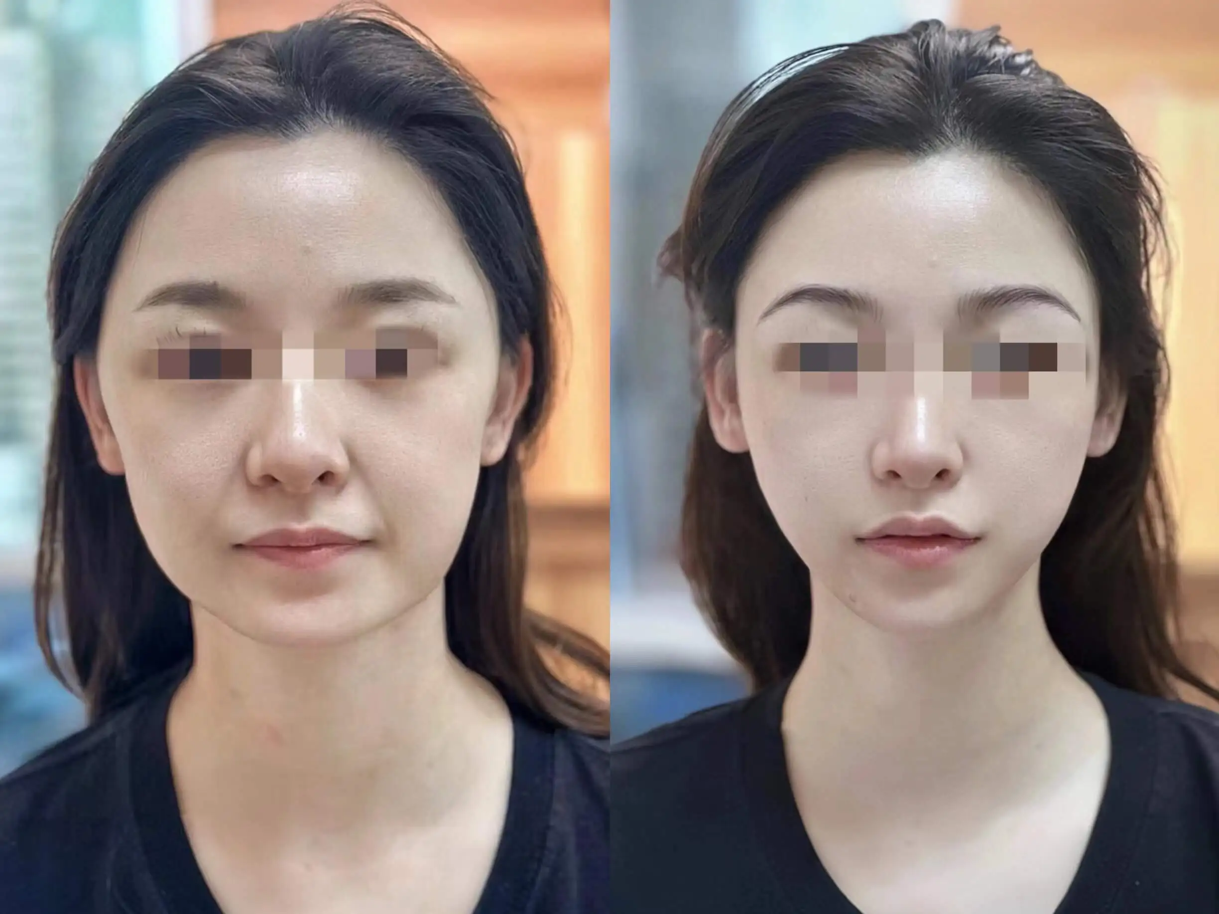 Sculptra Bangkok before and after - V-line lifting result at Edition Clinic