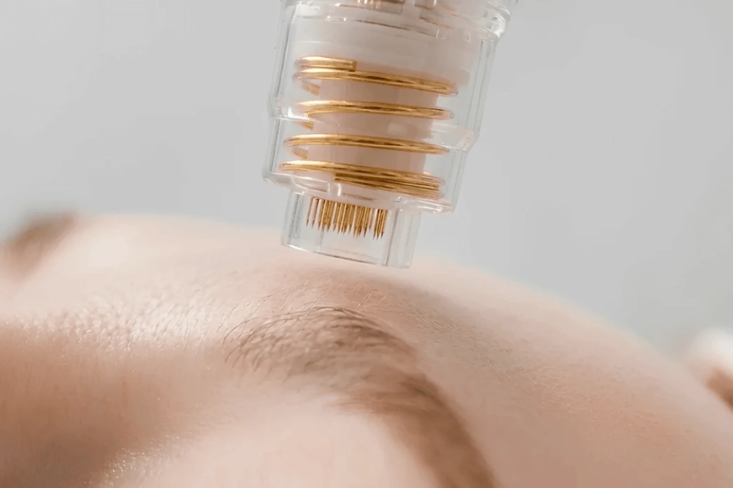 RF Microneedling for scars and skin rejuvenation