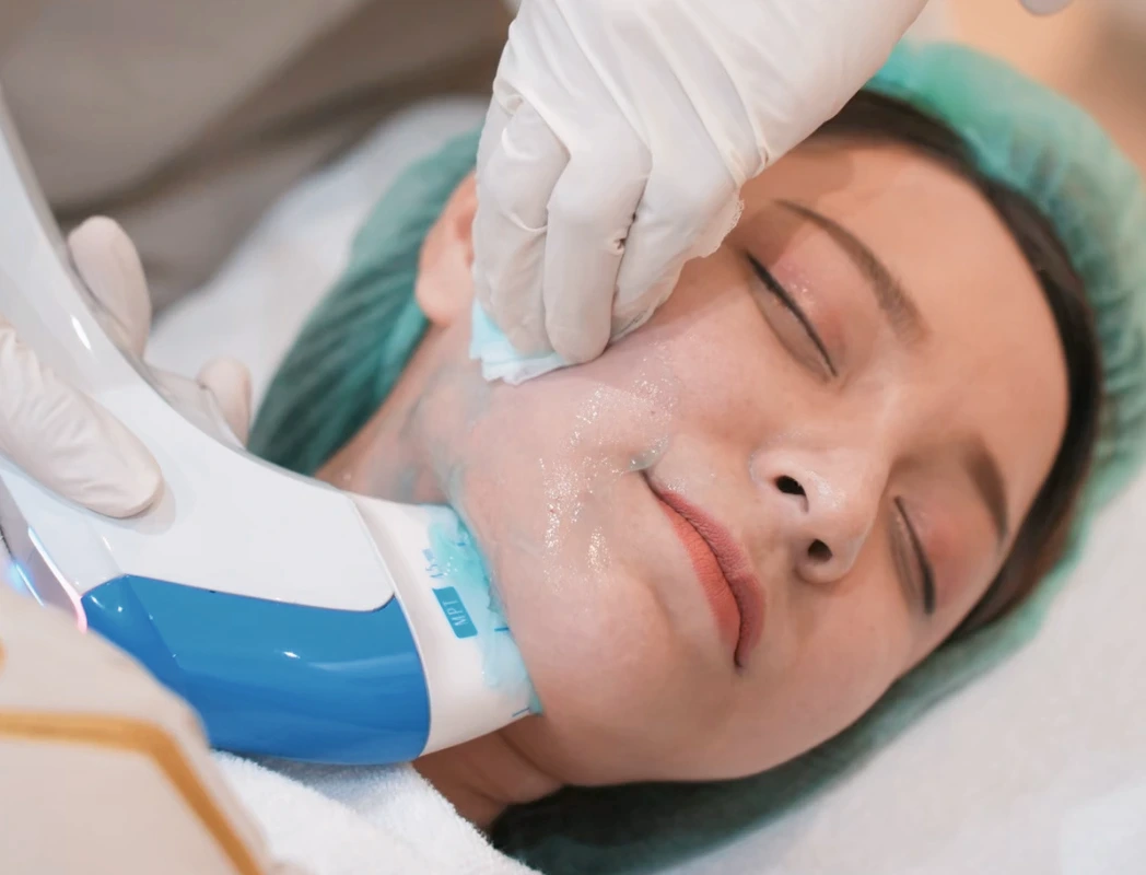 HIFU treatment technology — focused ultrasound targeting the SMAS layer