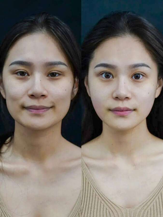 Before and after full face rejuvenation with Radiesse filler at Edition Clinic Bangkok