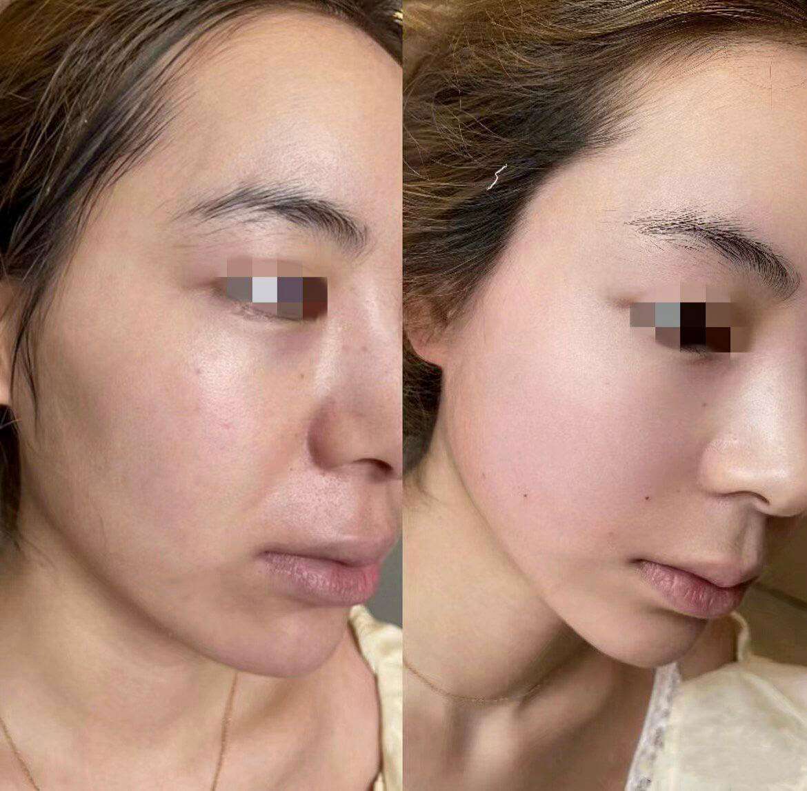 Midface volume restoration and nasolabial fold correction with Radiesse injection at Edition Clinic