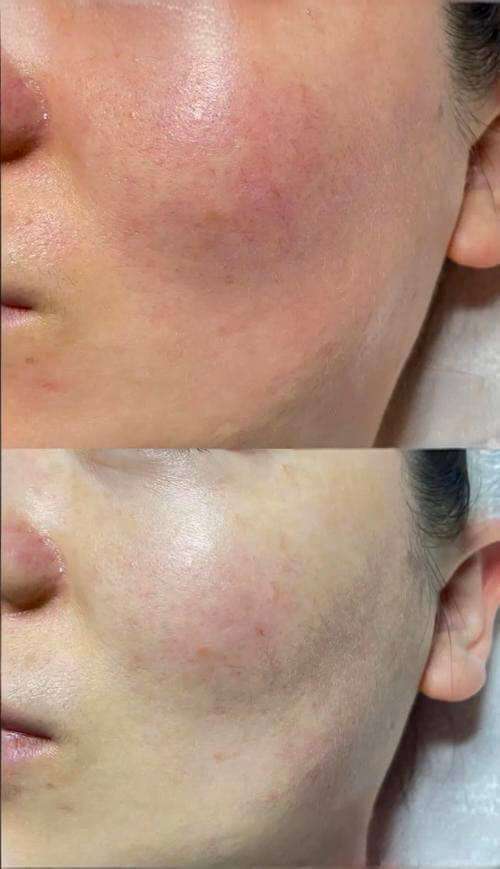 Skin texture and redness improvement after Radiesse treatment at Edition Clinic Bangkok