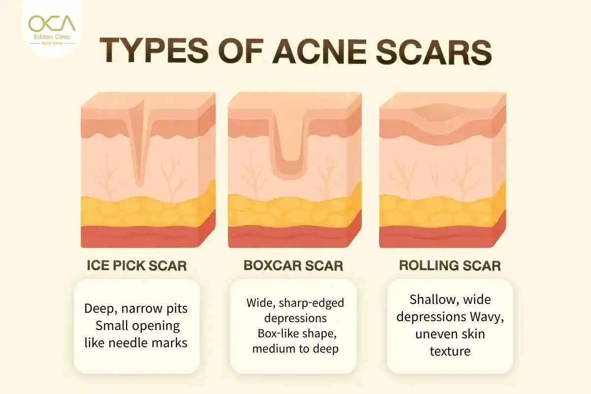 Types of acne scars - Rolling, Boxcar, and Ice Pick scar comparison at Edition Clinic Bangkok