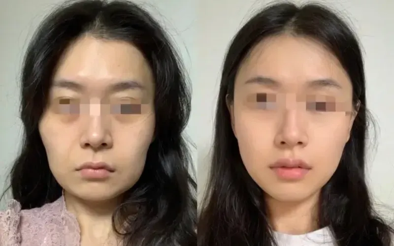 Juvelook before and after full face results at Edition Clinic Bangkok