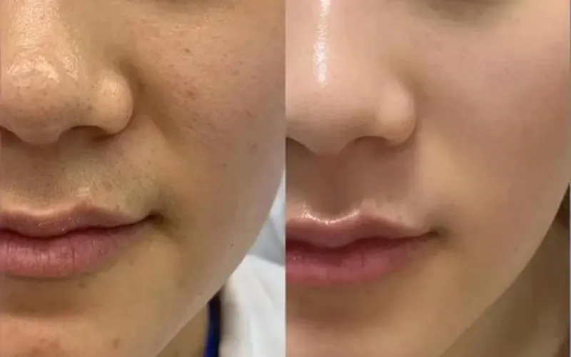 Juvelook before and after pores and texture improvement at Edition Clinic Bangkok