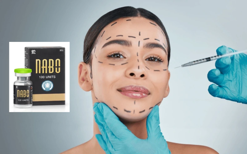 Nabota botox treatment areas: glabellar lines, forehead, crow's feet, masseter