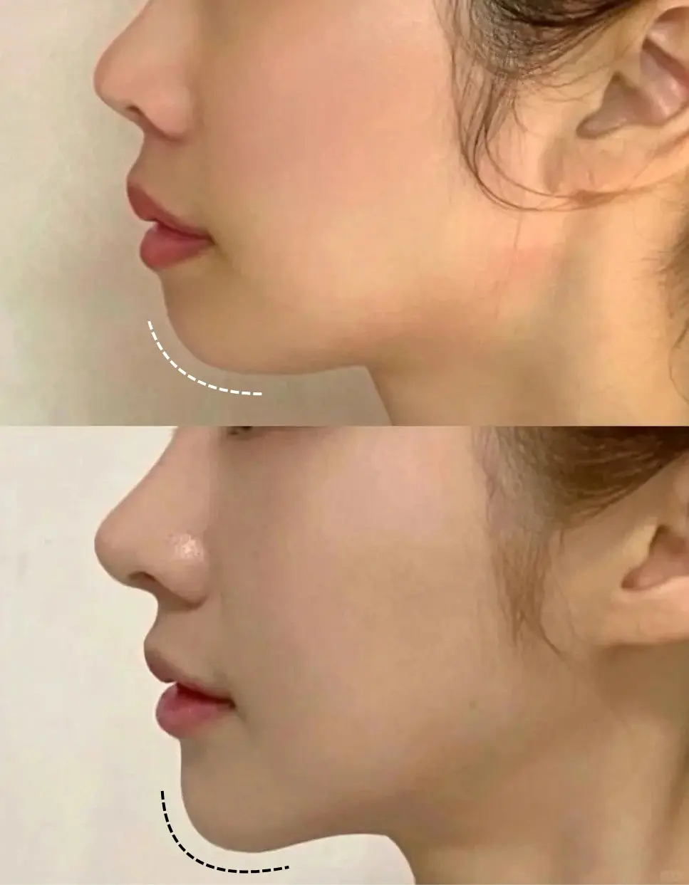 Chin filler before and after results at Edition Clinic Bangkok Thonglor