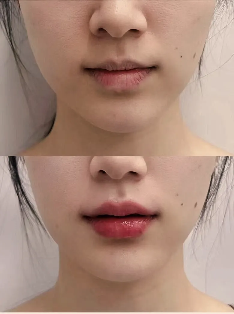 Lip filler before and after case 1 at Edition Clinic Bangkok Thonglor