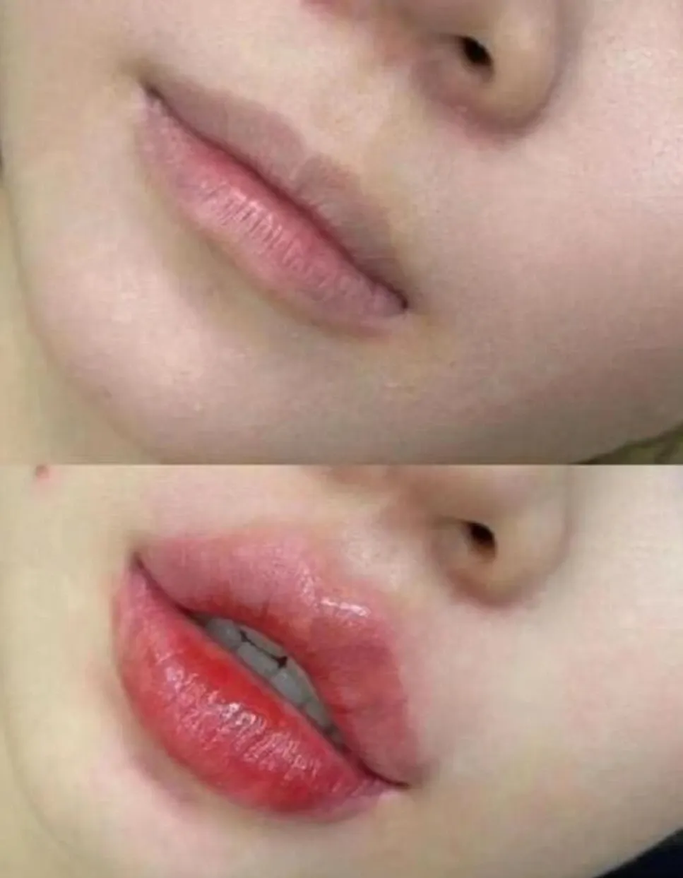 Lip filler before and after results at Edition Clinic Bangkok Thonglor